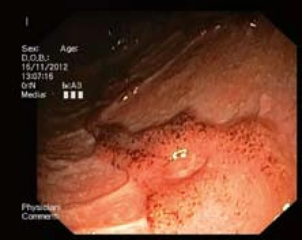 Těžká ulcerózní kolitida s rozsáhlými vředy.
Fig. 3. Serious ulcerative colitis with extensive ulcers.

