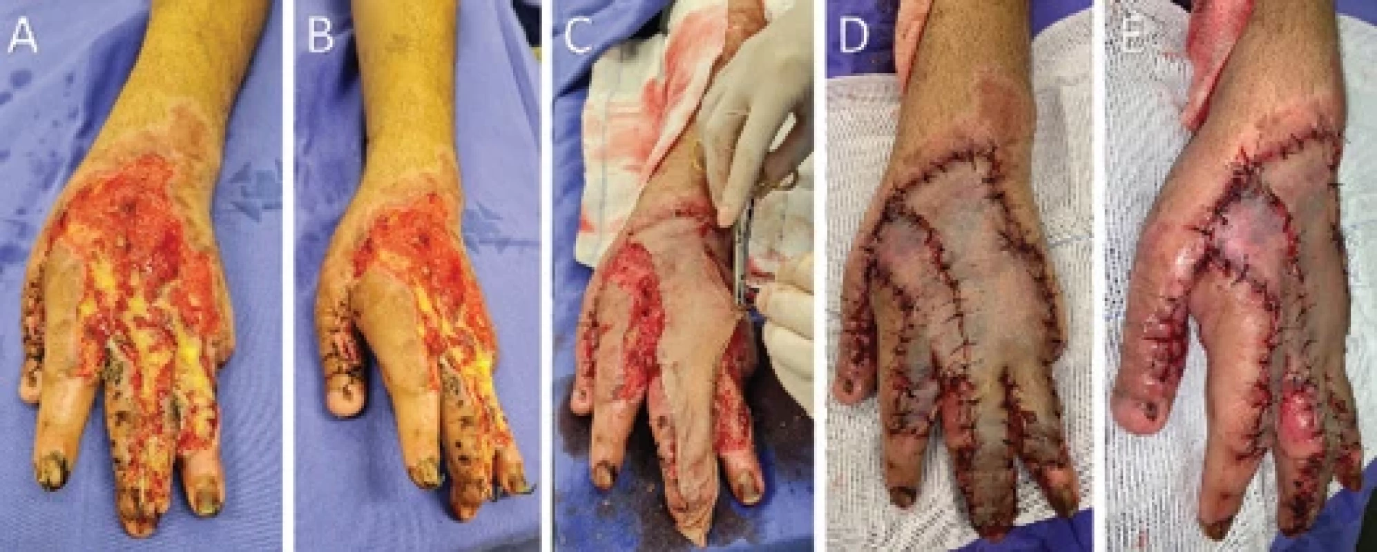 A) Initial appearance of the hand 7 days after the fourth debridement with fat graft and vacuum dressing, anterior view; B) at this time, the surgical debridement procedure was performed along with the removal of Kirschner wires and partial fi ne glabrous skin harvesting from the ipsilateral forearm for the skin graft over the entire dorsum of the hand and fi ngers, superior view; C) partial skin graft was positioned over the granulation tissue on the dorsum of the hand; D) superior view; E) lateral view. Subsequently, a compressive dressing was applied using rayon, sterilized liquid petroleum, cotton gauze, and bandaging.