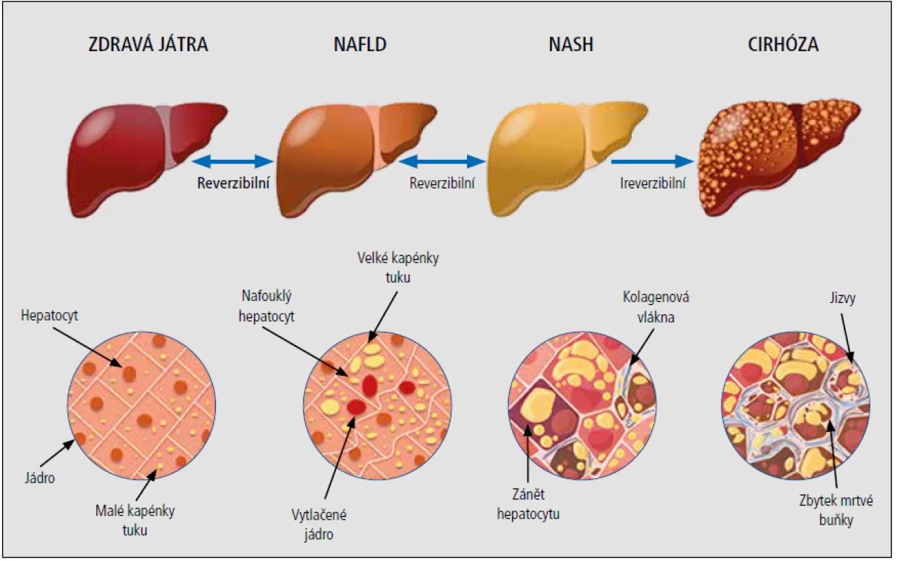 Progrese NAFLD. [Upraveno podle: darshanhospital.com]