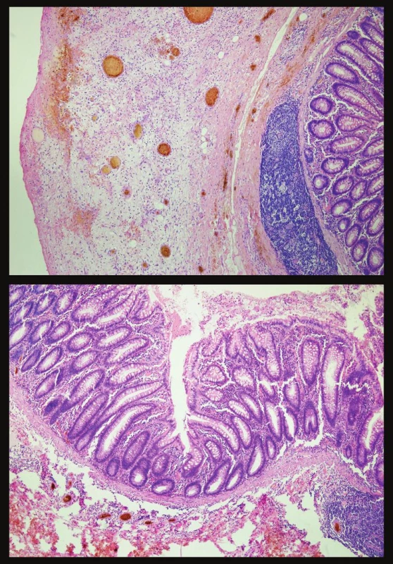 Histologický obraz zapáleného pseudodivertikla
Fig. 3. Histological view of the inflamed pseudodiverticle