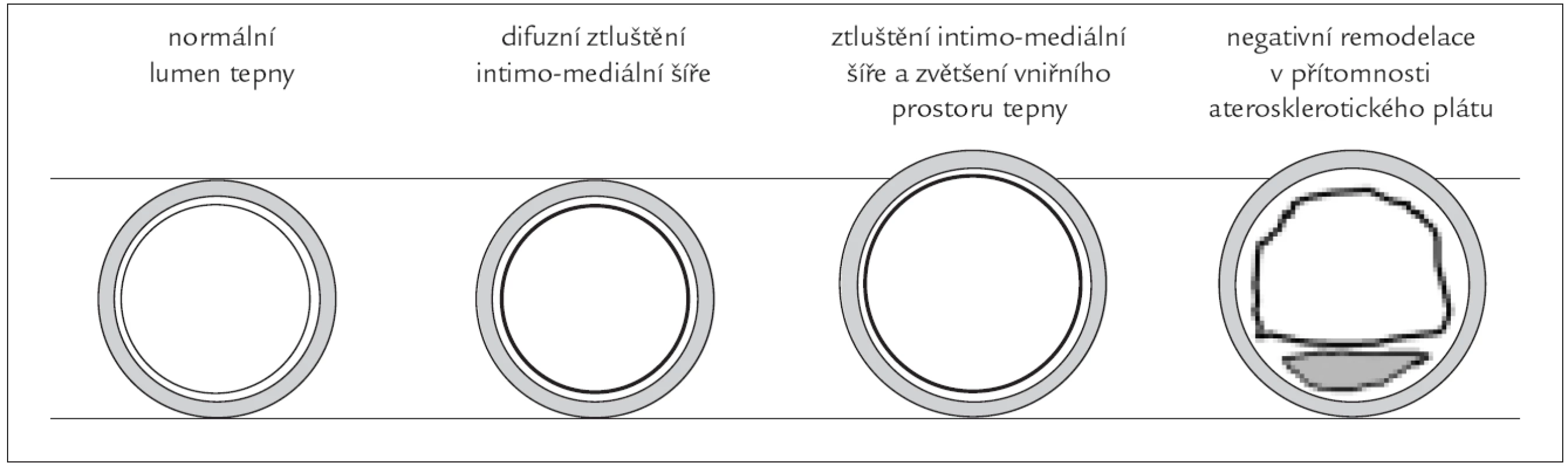 Pozitivní remodelace cévní stěny při zachování vnitřního lumen cévy a negativní remodelace při zmenšení průsvitu cévy.