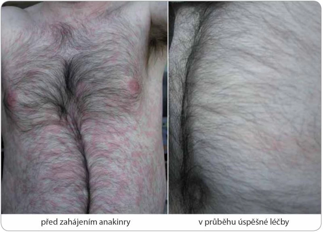 Kompletní remise Schnitzler-syndromu po zahájení anakinry u případu 5.