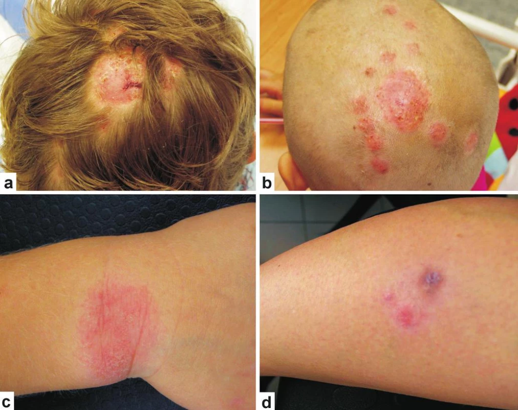 Tinea capitis profunda a tinea corporis vyvolaná <i>A. benhamiae</i>