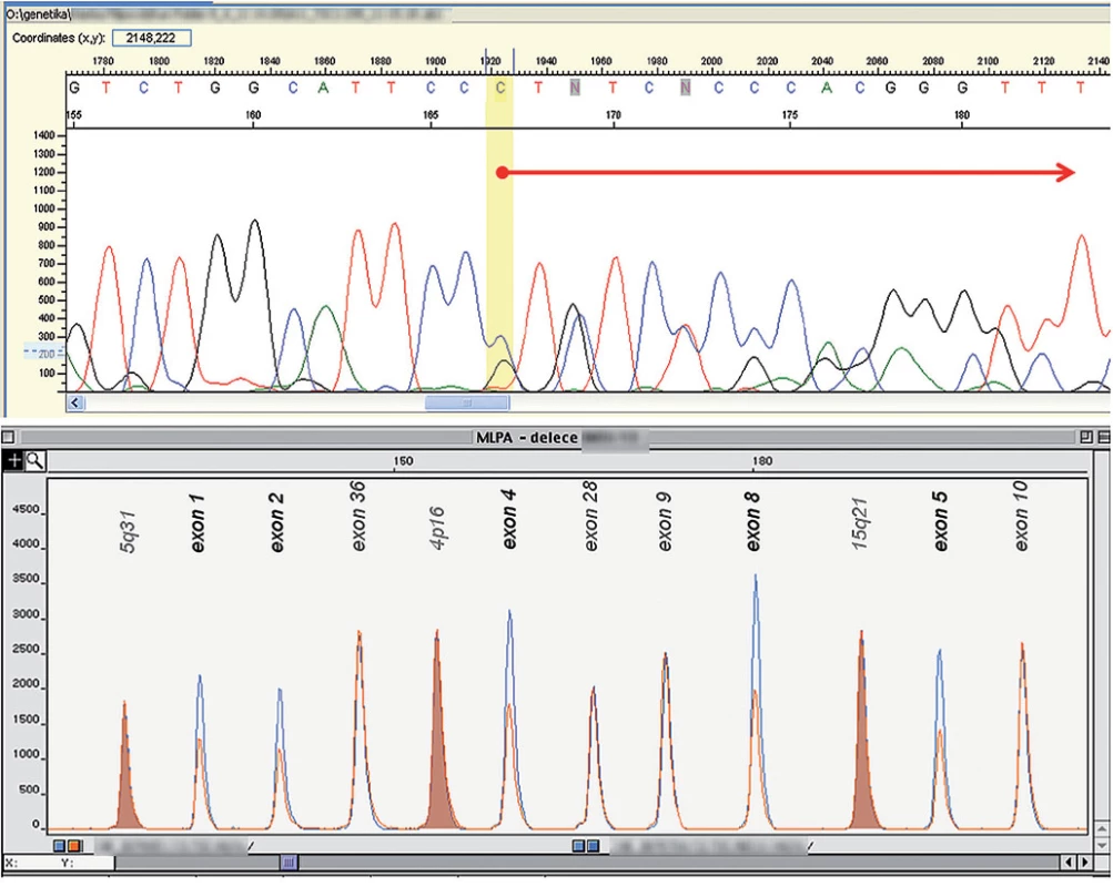 DNA analýza u pacientů 1 a 2. 
Obr. 2a) Pacient 1: mutace TSC1 genu – 15. exon: c.1708_1709del, Arg570Glyfs*17 (sekvenace s rev. primerem). Šipka označuje posun sekvence vzniklý v důsledku delece AG. 
Obr. 2b) Pacient 2: detekce delece prvních osmi exonů TSC2 genu – výsek fragmentační analýzy, metoda MLPA. Modře – kontrolní DNA, červeně – pacientova DNA; u pacienta je patrna redukce signálu v deletovaných exonech TSC2 genu.