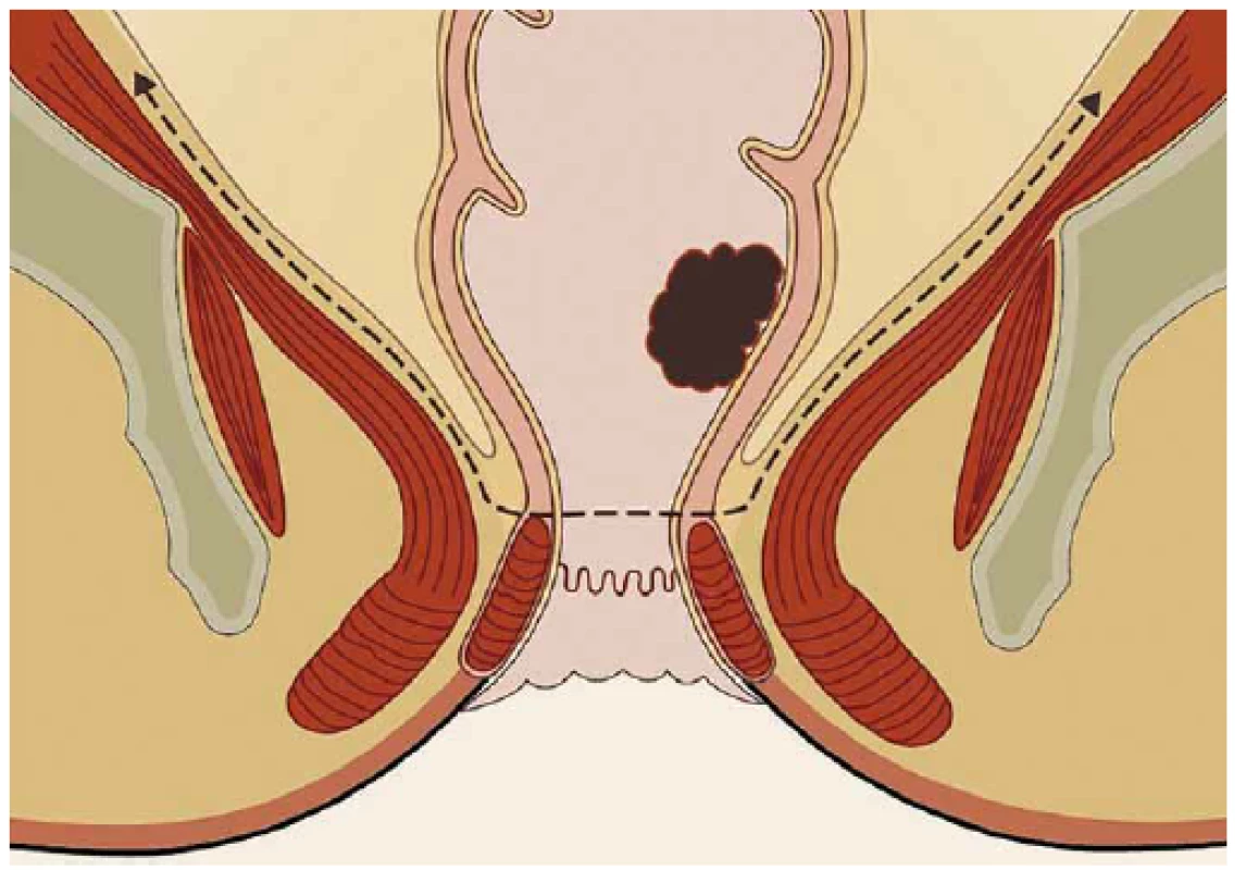 Princip resekce rekta metodou TAMIS-TME – down to top strategie
Fig. 4. Rectal resection using the TAMIS-TME method – a down-to-top strategy