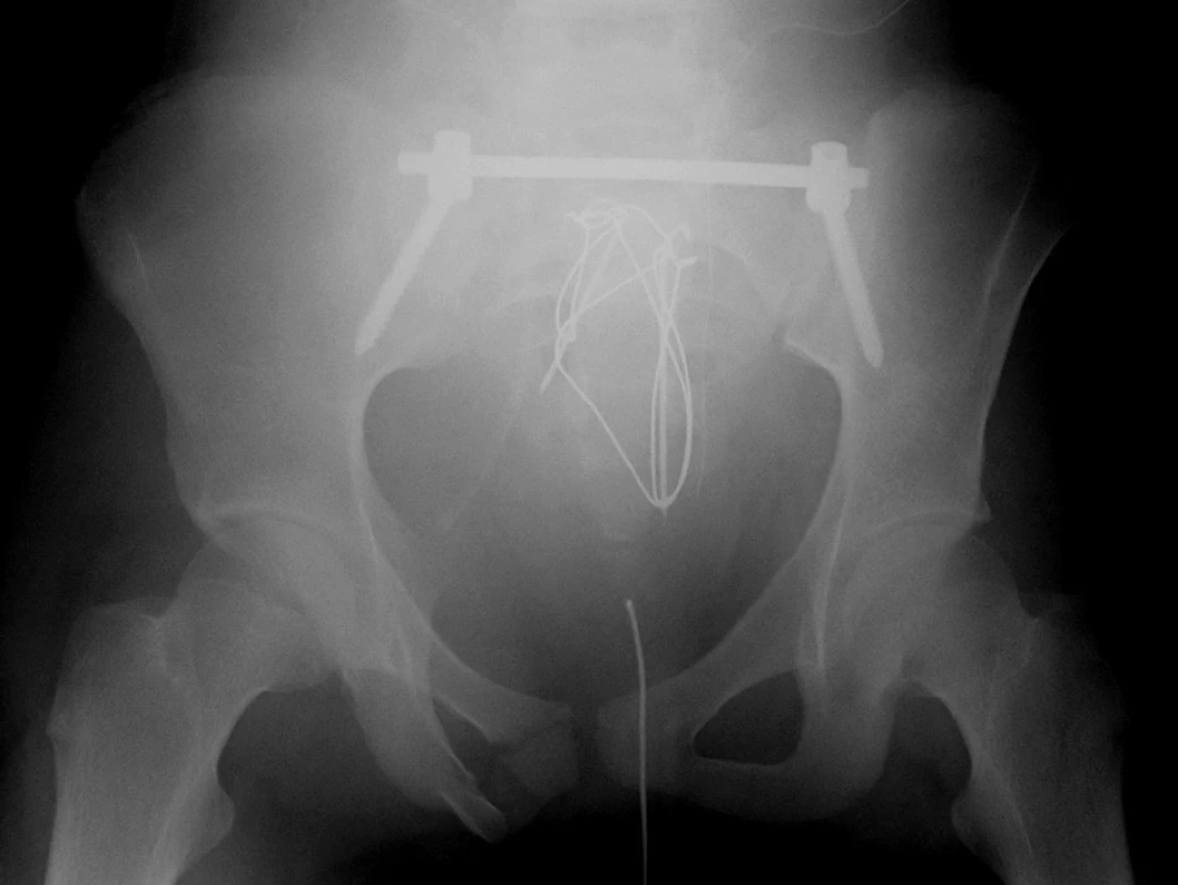 Ošetření nestabilní zlomeniny sakra dvojitou cerkláží sakra a zajištěním zadního segmentu pánve transiliakální fixací (TIFI)
Fig. 4: Treatment of unstable sacral fracture with double cerclage and fixation of the posterior pelvic segment with transiliac fixation (TIFI)