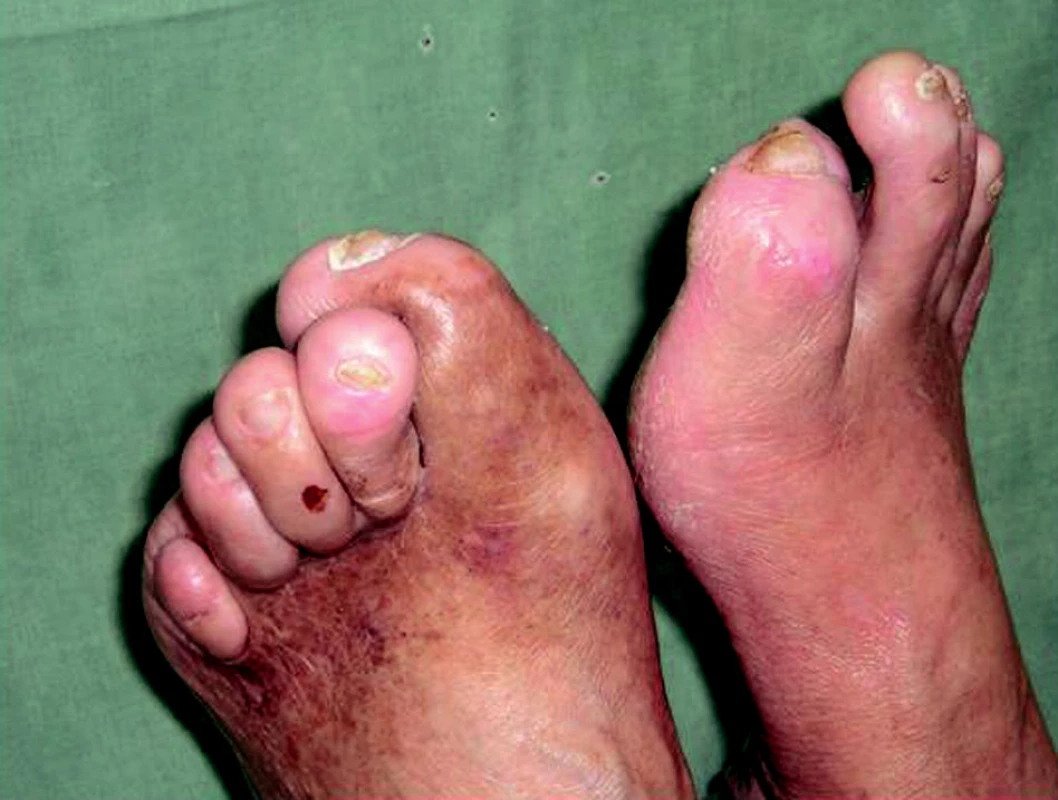 Deformity dolních končetin u pacienta se SDN.