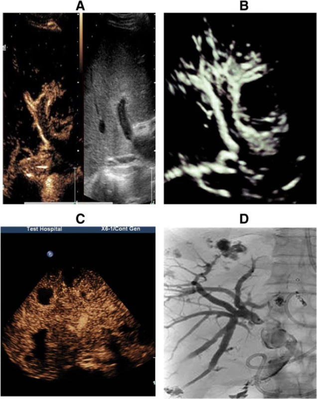 a and (b) Collateral circulation was observed on both CEUS and 3D-CEUS. c and (d) Bilomas were observed on CEUS and PTCD