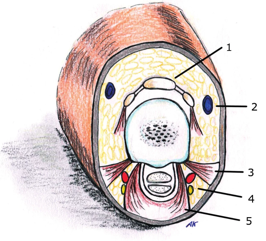 Anatomy of ligaments in the fingers
1. Extensor tendon
2. Dorsal vein
3. Cleland’s retrovascular ligament
4. Neurovascular bundle
5. Grayson’s prevascular ligament