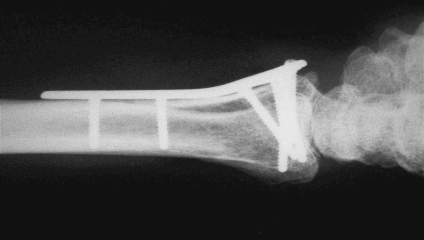 Princip fixace fragmentů dvěma distálními řadami šroubů v různých směrech
Fig. 1. The principle of the fragment fixation with two distal rows of screws in various directions