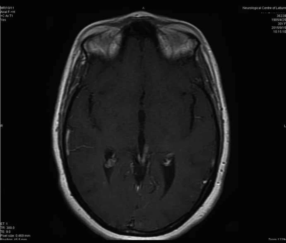 Transversal T1 MRI constrast enhanced section at 33 months from surgery.