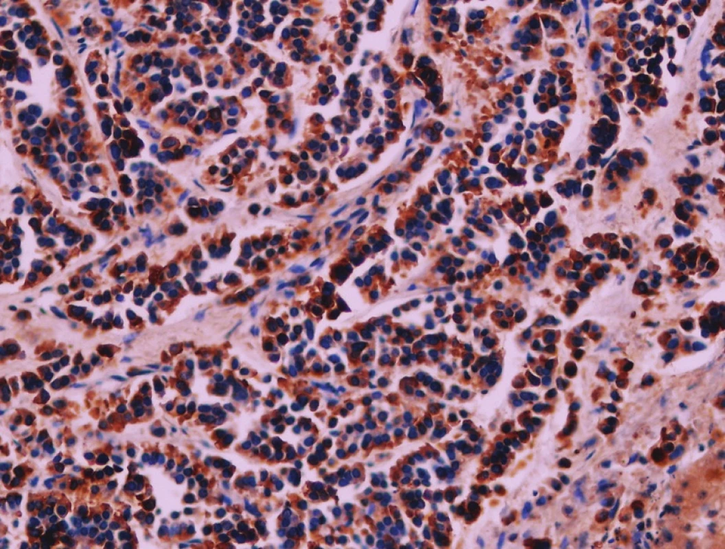 Exprese chromograninu. Imunohistologie, 400x