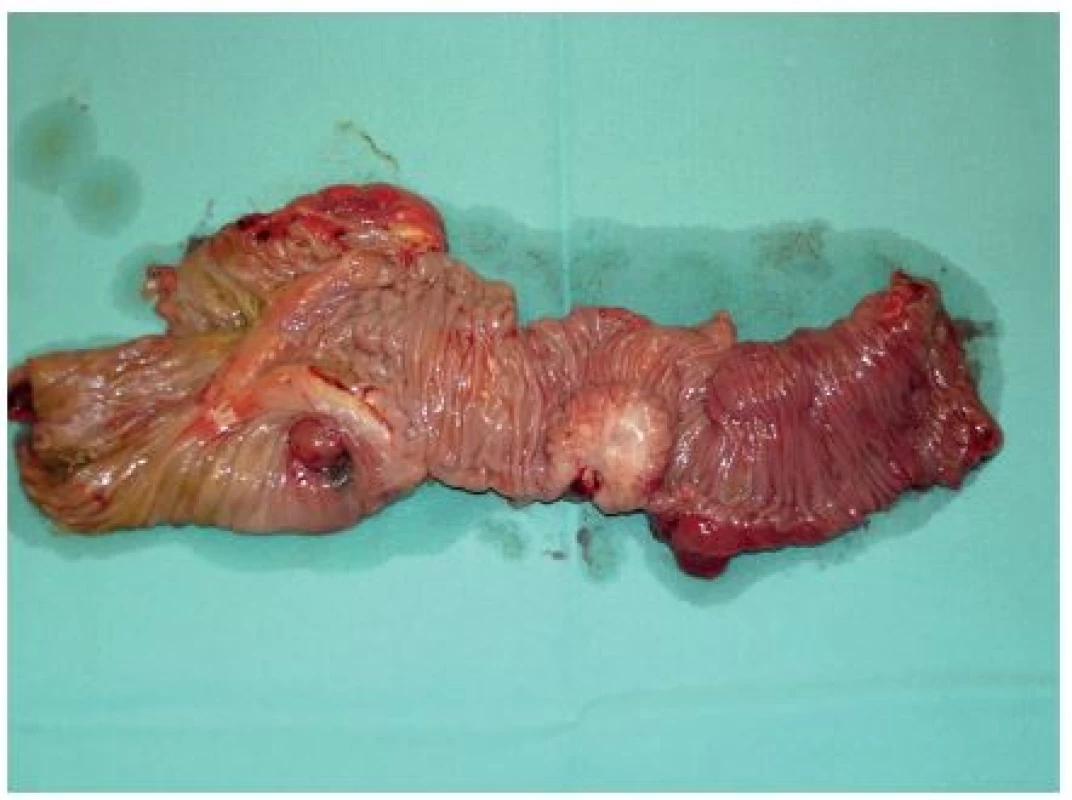 Rozstřižený resekát ileocekální oblasti, bělavé tumurózní ložisko s prokrvácením ve stěně terminálního ilea
Fig. 2: Ileocaecal resection, white tumour-like lesion with haemorrhage in the wall of the terminal intestine