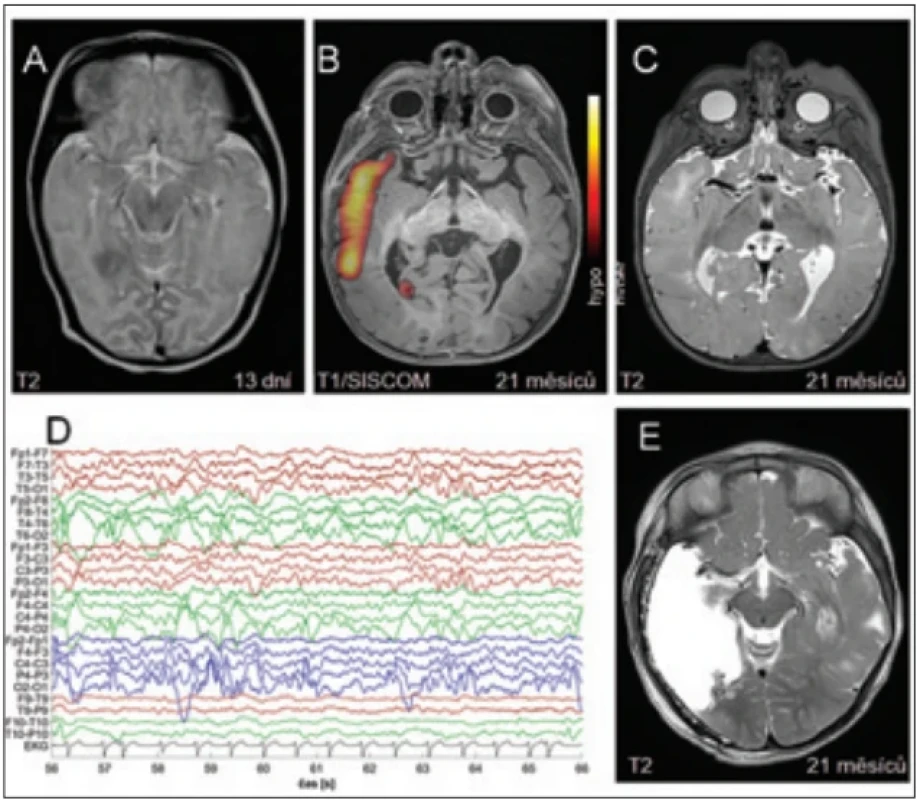 Pacient P1 z obr. 1 podstoupil rozšířenou temporální resekci vpravo pro diagnózu TSC. (A) MR – T2 axiální sekvence ve 13 dnech věku ukazují hypointenzní ložisko v pravém temporálním laloku; (B) korelující nález iktální hyperperfuze na vyšetření SPECT; (C) MR – T2 axiální sekvence ve 21 měsících věku ukazují hyperintenzní ložiska, v pravém temporálním laloku i se ztluštěním kortexu; (D) rytmická epileptiformní aktivita nad pravým zadním kvadrantem na předoperační video-EEG, na EKG svodu je patrná i arytmie v souvislosti se srdečními rhabdomyomy při základní diagnóze; (E) pooperační MR, T2 sekvence. SPECT – single photon emission computed tomography; TSC – tuberózní skleróza Fig. 3. Patient P1 from Fig. 1 with a diagnosis of TSC underwent an extended right temporal resection. (A) MRI – axial T2-weighted images at 13 days of age show a hypointense lesion in the right temporal lobe; (B) corresponding ictal hyperperfusion on SPECT; (C) MRI – axial T2-weighted images at 21 months of age show hyperintense lesions, including a right temporal lesion with cortical thickening; (D) rhythmic epileptiform activity over the right posterior quadrant on preoperative video-EEG; the ECG channel shows also arrhythmia related to cardiac rhabdomyomas associated with the underlying diagnosis; (E) postoperative MRI, T2-weighted image. SPECT – single photon emission computed tomography; TSC – tuberous sclerosis complex