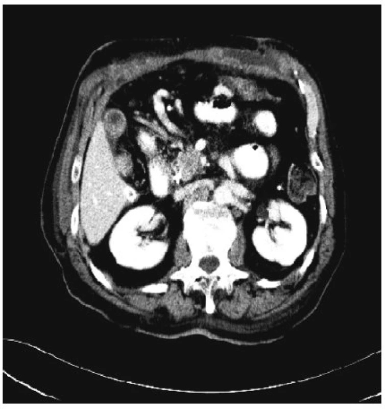 Předoperační CT zobrazující maligní neuroendokrinní tumor těla pankreatu
Fig. 3. Preoperative CT scan depicting a tumor of the pancreatic head