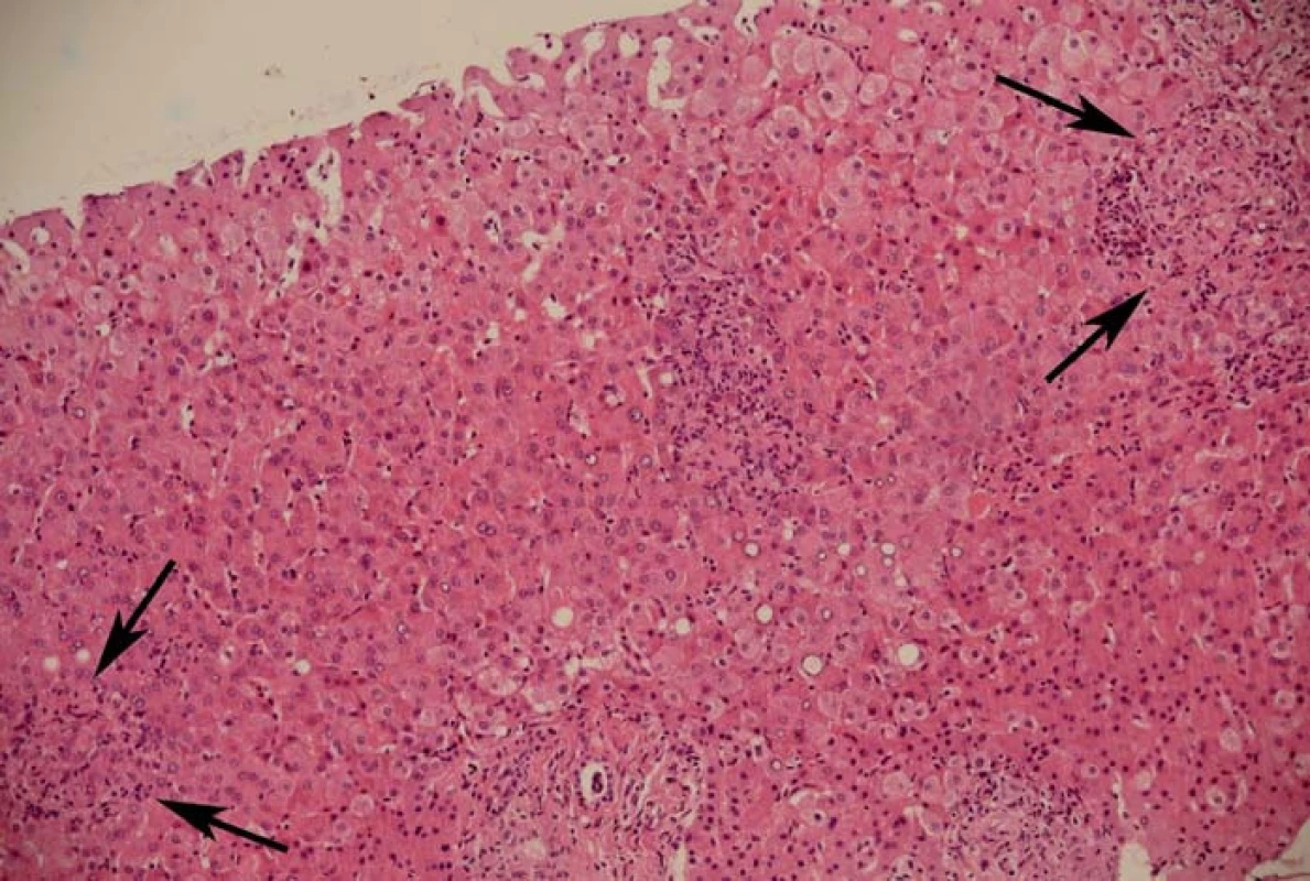 Jaterní biopsie – punkční váleček jaterního parenchymu délky 6 mm se zánětlivou, převážně lymfocytární infiltrací, s neutrofilními granulocyty a „interface“ aktivitou. Jaterní parenchym je lobulárně uspořádaný s četnými hepatocyty s balonovitou degenerací, místy zřetelně zformovanými cholestatickými rozetami. Často nacházíme nekazeifikující epiteloidní granulomy (šipky) infiltrované lymfocyty a některé i s obrovskými buňkami Langhansova typu.
Fig. 1. Liver biopsy – liver biopsy specimen, length 6 mm, with inflammatory infiltration, consisting almost entirely of lymphocytes, with neutrophils and interface hepatitis. Liver tissue with lobular arrangement with numerous ballooning hepatocytes and markedly formed cholestatic liver cell rosettes. There are frequently found non-caseating epithelioid granulomas (marked with arrows) infiltrated with lymphocytes and some with Langhans giant cells.