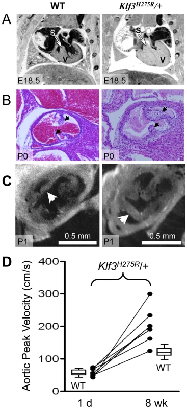 Abnormal hearts and aortic valves in <i>Klf3</i><sup>H275R</sup>/+ neonates.