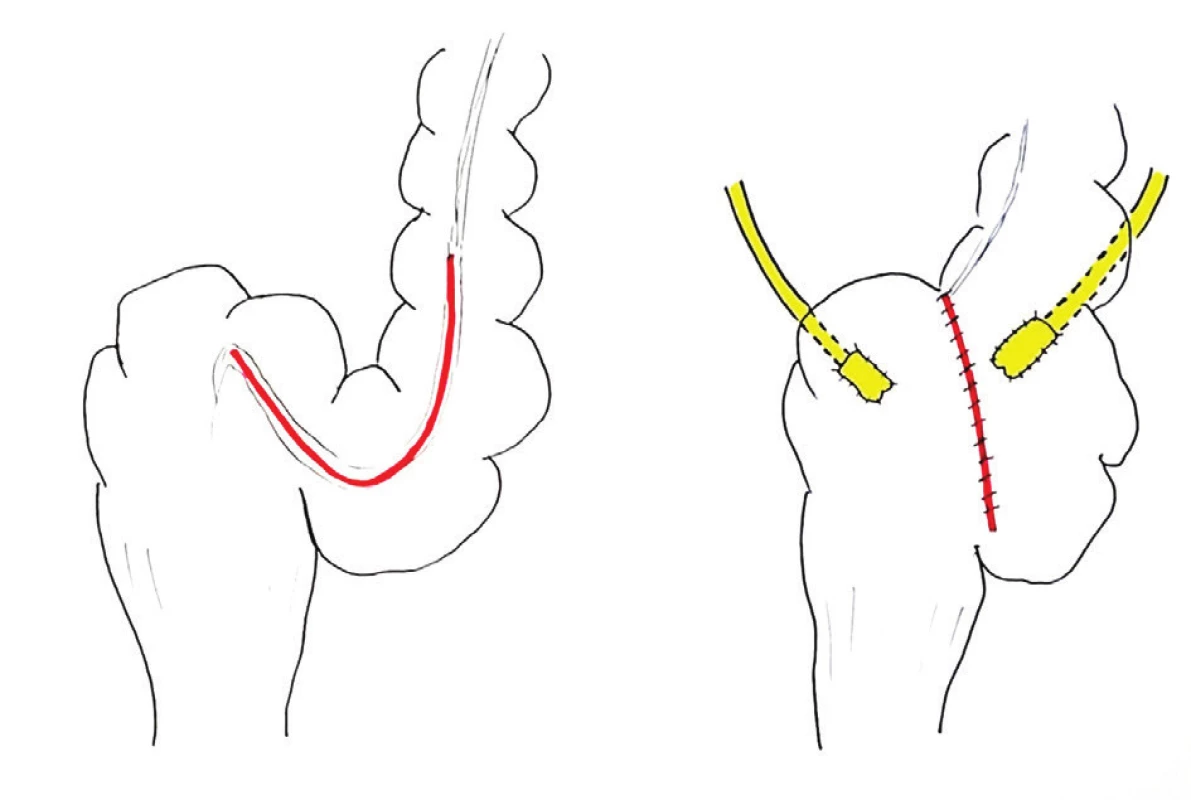 Sigma-rectum pouch (Mainz Pouch II) – shema: detubularizace 20 cm sigmatu nad rektosigmatickým přechodem; konstrukce sférického pouche, do jehož dorzální stěny jsou antirefluxně vyústěny uretery metodou FT. Kontinenci moče (a stolice) zajišťuje anální svěrač.
Fig. 7: Sigma-rectum pouch (Mainz pouch II) – diagram: 20 cm of detubularization, spheric configuration, antirefluxing FT UIA at the dorsal wall