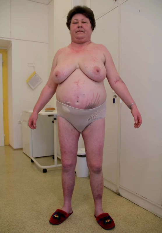 Vzhled pacientky s Cushingovým syndromem (archiv autora).
