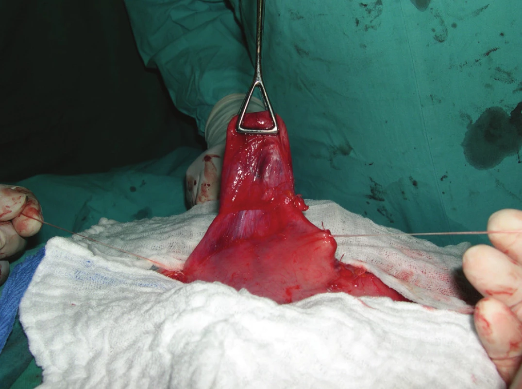 Intraoperačný nález divertikula
Fig. 3: Peroperative view of the finding