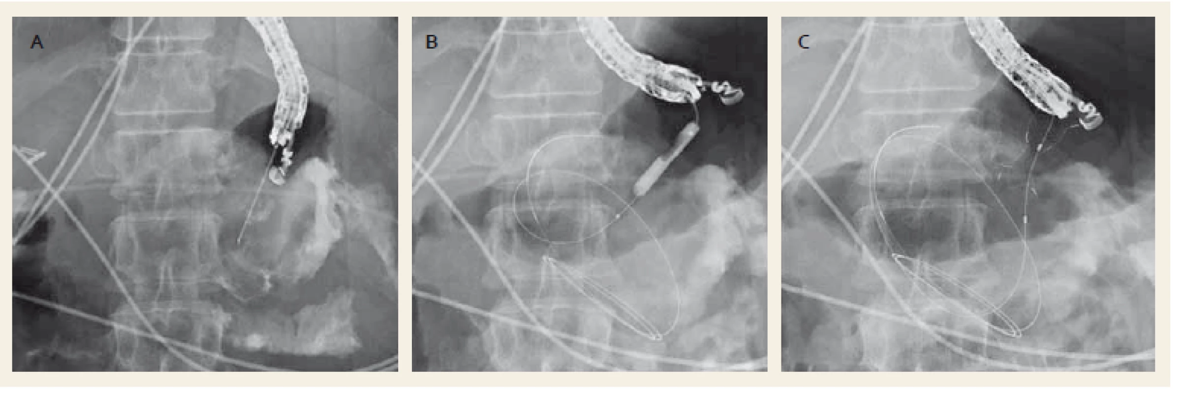 Drenáž ohraničené nekrózy metalickým stentem Nagi™ (Taewoong Medical Co., Ltd., Ilsan, South Korea). Punkce kolekce jehlou (A), dilatace anastomózy balonkem (B), zavedený metalický stent (C).
Fig. 2. Drainage of a walled-off necrosis with a Nagi™ metal stent (Taewoong Medical Co., Ltd., Ilsan, South Korea). Puncture of the collection with a needle (A), dilation of anastomosis with a balloon (B), drainage with a metal stent (C).