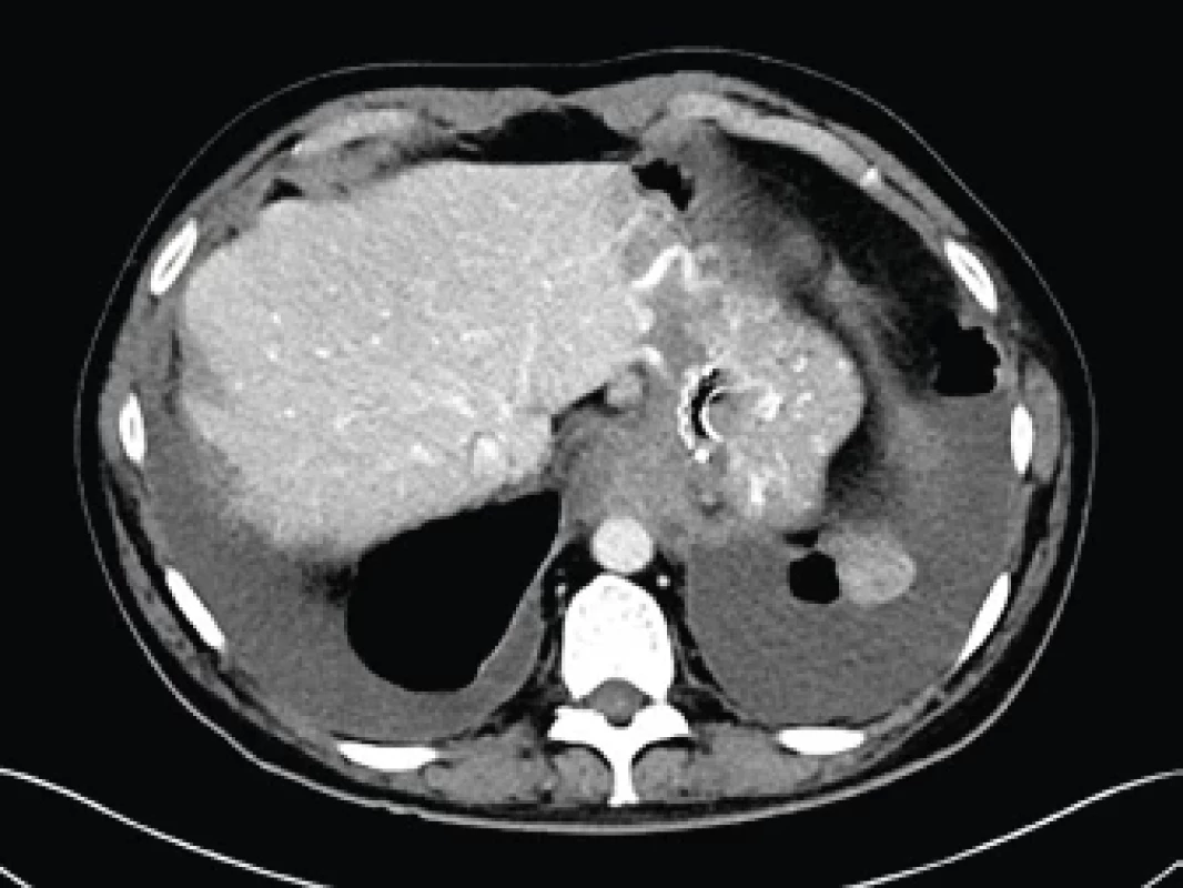 CT snímek hrudníku – pseudocysta mediastina před drenáží – sagitální rekonstrukce.