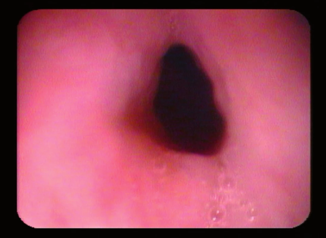 Ezofagoskopické vyšetrenie – primerane veľký lúmen v mieste Kilianovho zvierača.
Fig. 2. Esophagographic examination – average size of lumen in the region of Killian sphincter.