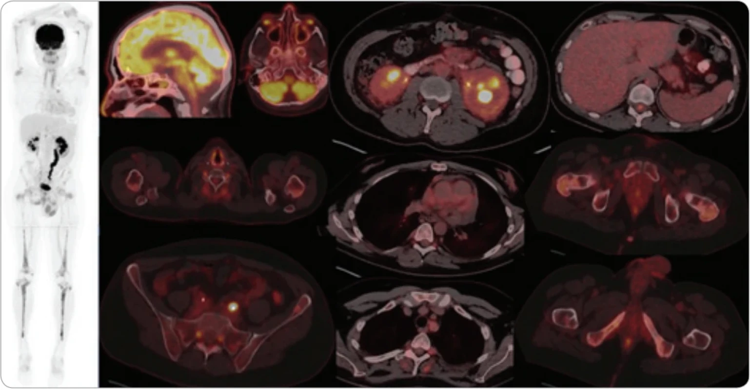 FDG PET/CT vyšetření po 4. cyklu léčby kladribinem, cyklofosfamidem a anakinrou. 