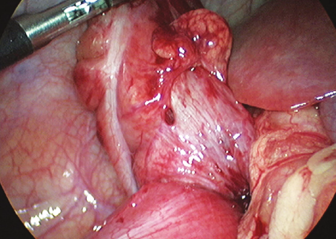 Ukončená laparoskopická dezinvaginácia – hladký prechod serózy distálneho ilea na cékum (foto: V. Cingel)
Fig. 3. Completed laparoscopic desinvagination – smooth transition between the distal ileal serosa and caecum (photo: V. Cingel)