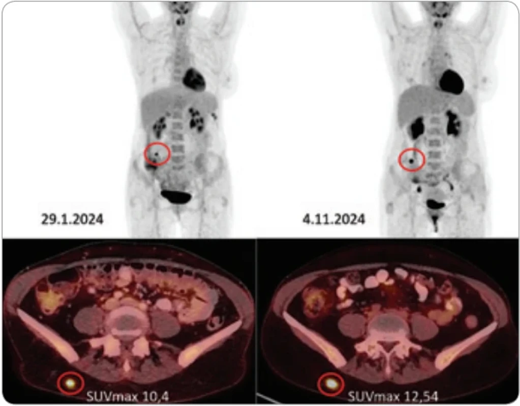 Dvě FDG-PET/CT vyšetření u naší pacientky. Nahoře MIP PET obraz v černobílé barevné škále, dole detaily PET/CT v axiálních řezech. Hypermetabolické ložisko (označeno) v čase zvýšilo metabolickou aktivitu, zvětšilo velikost, zůstalo solitární a ve stejné lokalizaci.