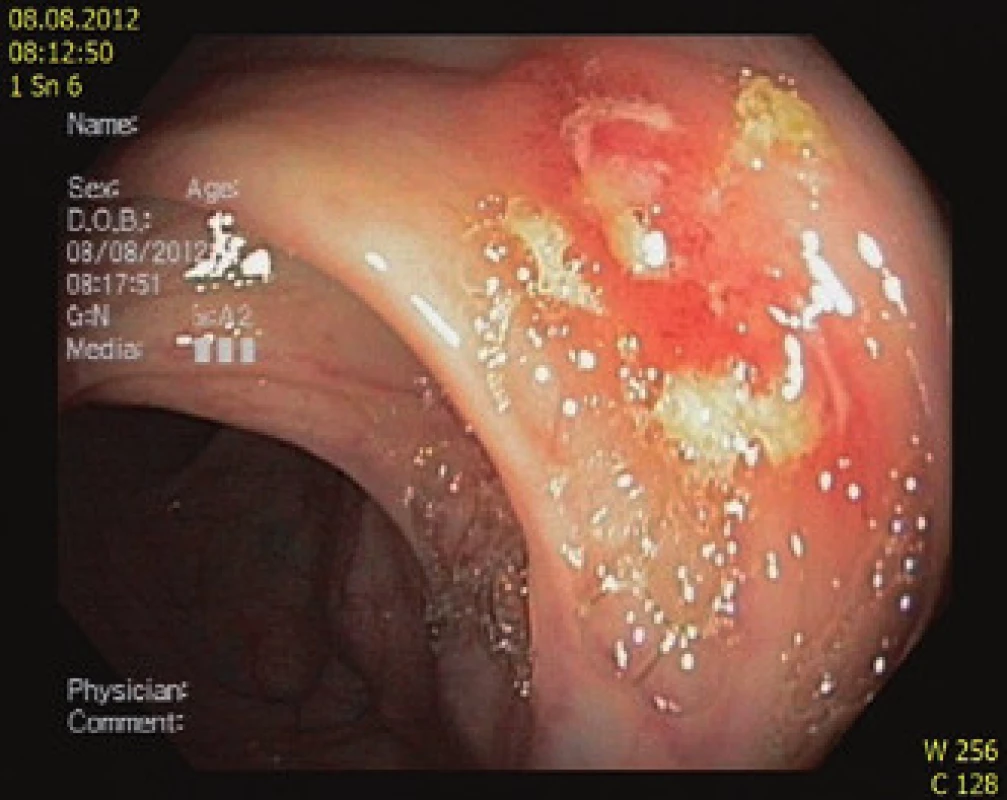 Endoskopický obraz: A – vřed terminálního ilea, B – vřed v tračníku.
Fig. 2. Endoscopic images: A – ulcer of terminal ileum, B – ulcer of colon.