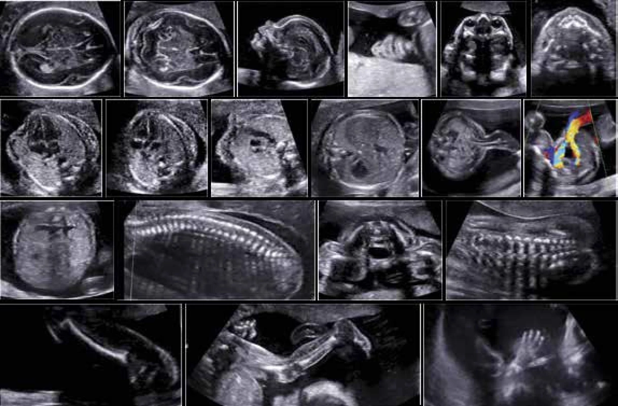 Ultrasonografické vyšetření morfologie plodu ve 2. trimestru dle FMF protokolu (normální nálezy)