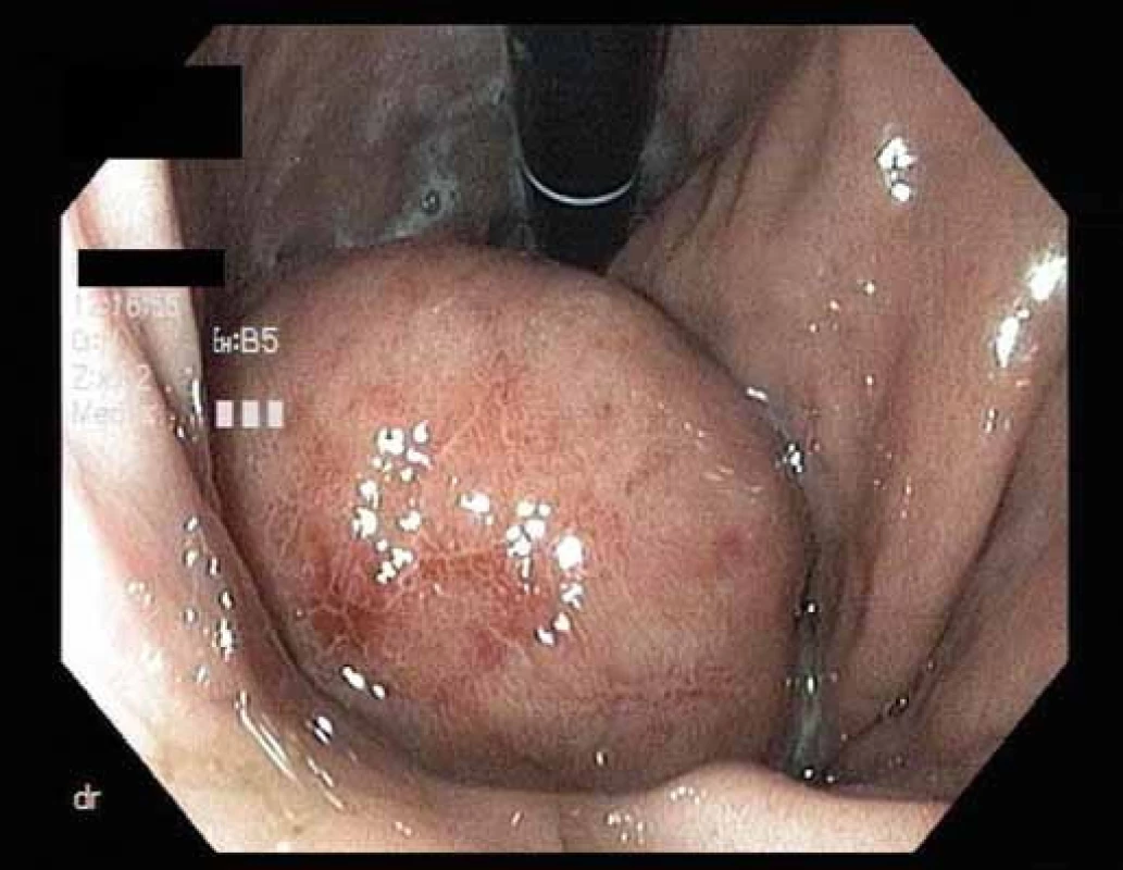 Endoskopický obraz submukózního nádoru v žaludku.
Fig. 1. Endoscopic image of submucosal tumor in the stomach.