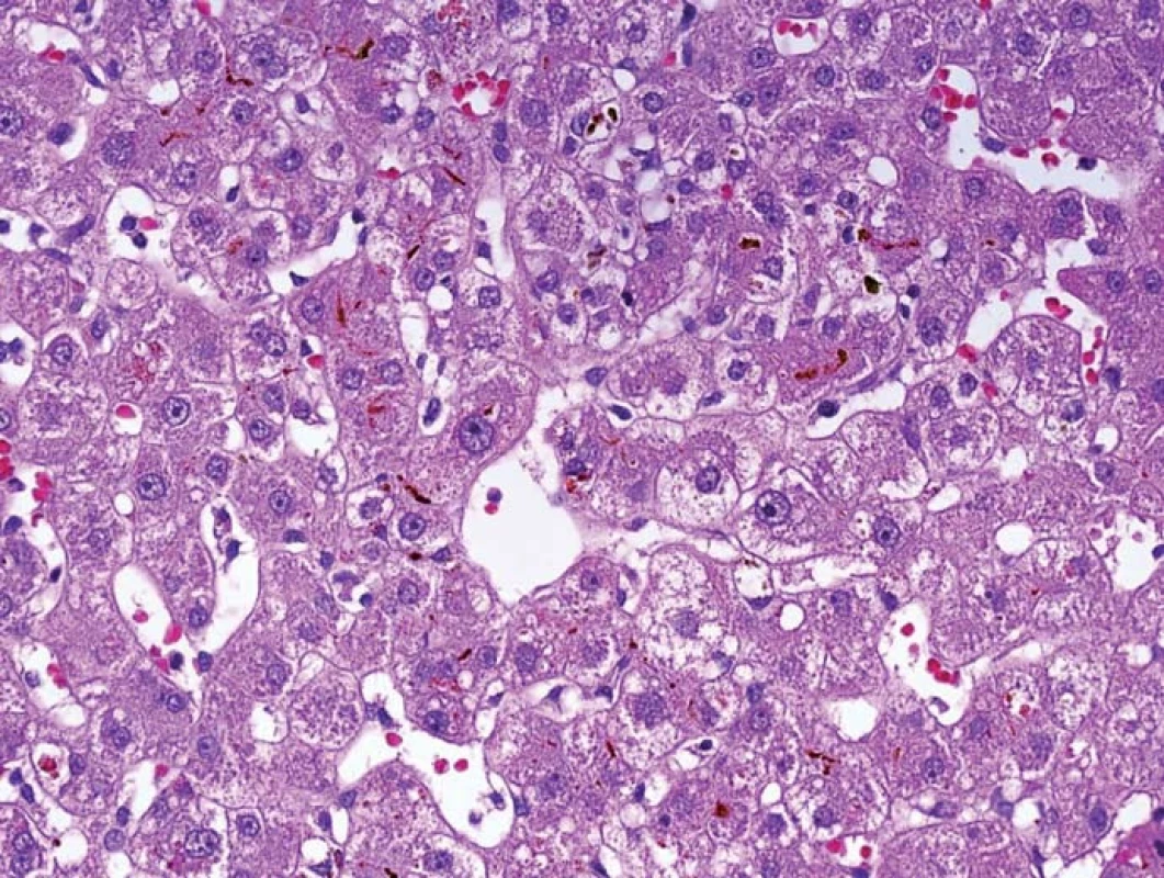 Ischemicko-reperfuzní poškození se zduřením hepatocytů a s intracelulární i intrakanalikulární cholestázou centrolobulárně.