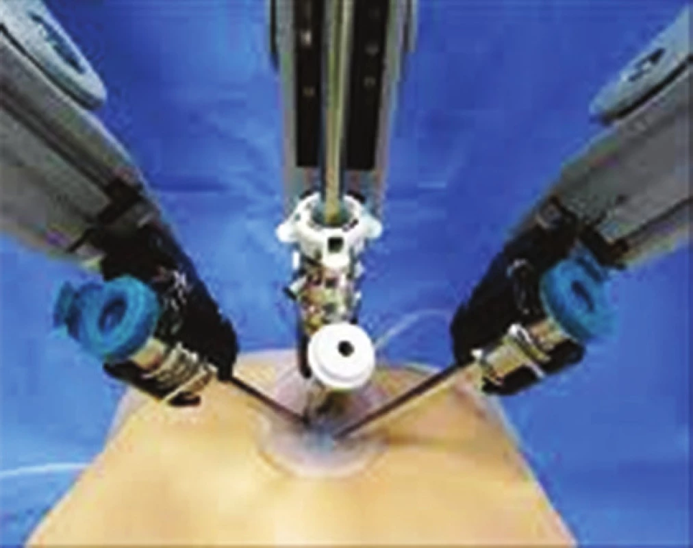 Single port robotická chirurgie
Fig. 6: Single-port robotic surgery
