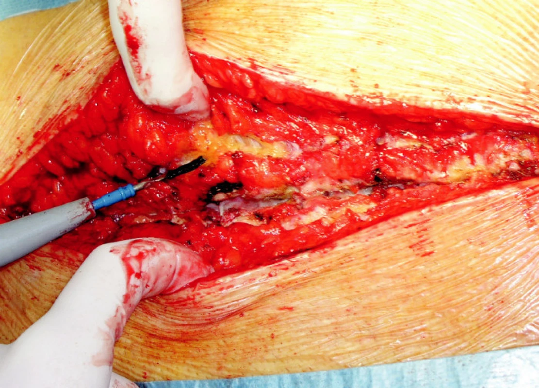 Peroperační snímek dehiscence hrudní kosti
Fig. 4. The sternal dehiscence peroperative view