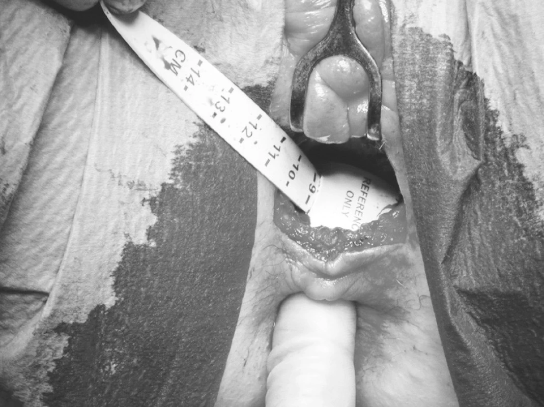 Peroperační snímek: kalibrace manžety umělého svěrače
Pic. 3. Situation during surgery: calibration of the cuff