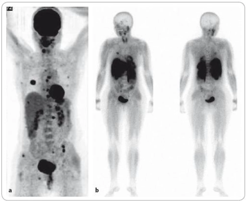 Nově diagnostikovaný mnohočetný myelom ve stadiu III. <sup>18</sup>F-FDG PET/CT vyšetření – MIP obraz – „maximum intenzity projection“ (a) a celotělová <sup>99m</sup>Tc-MIBI scintigrafie (b). Na obrazu MIP lze diferencovat vícečetná ložiska hypermetabolizmu glukózy v oblasti hrudníku, páteře a pánve, při <sup>99m</sup>Tc-MIBI scintigrafii je počet fokálních lézí evidentně nižší.