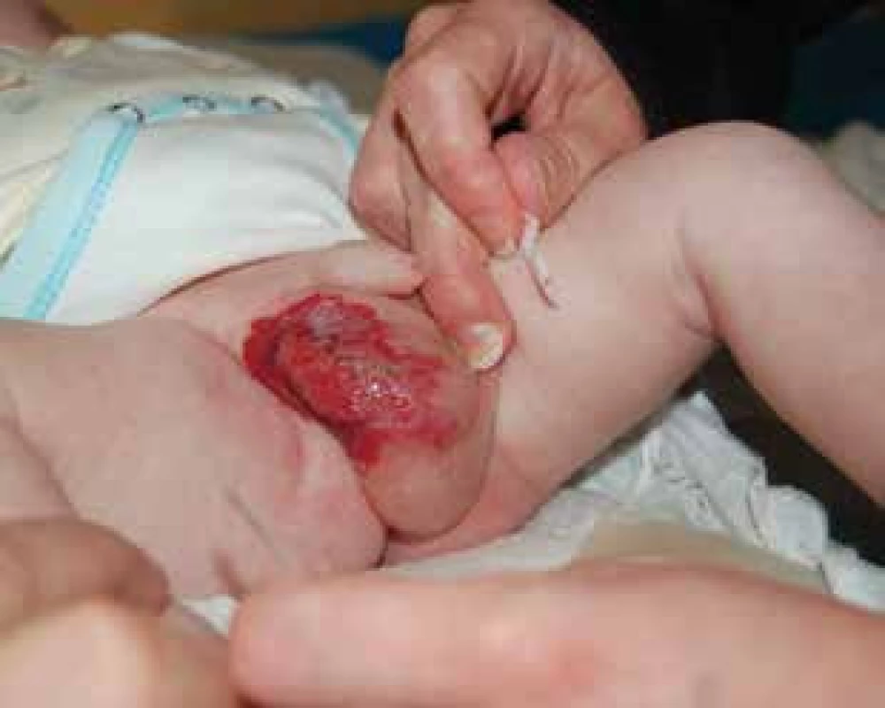 Ulcerovaný infantilní hemangiom skrota.
Fig. 9. Ulceration of scrotal infantile hemangioma.