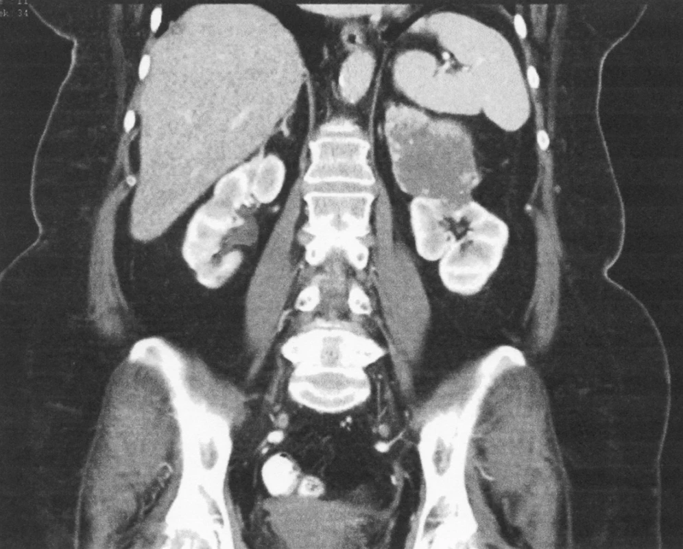 CT – koronární řez – obraz zobrazující tumor levé nadledviny. Histologicky karcinom kůry
Fig. 3. CT – coronary section – depicting a tumor of the left adrenal gland. Histology confirmed carcinoma of the adrenal cortex