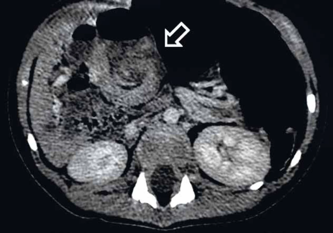 CT obraz „whirlpool sign” tvorený otočením stredného čreva a priľahlého mezentéria okolo osi tvorenej arteria mesenterica superior.
Fig. 2. CT finding of the „whirlpool sign“ – twisting of the midgut and the adjacent mesentery around the axis formed by superior mesenteric artery.