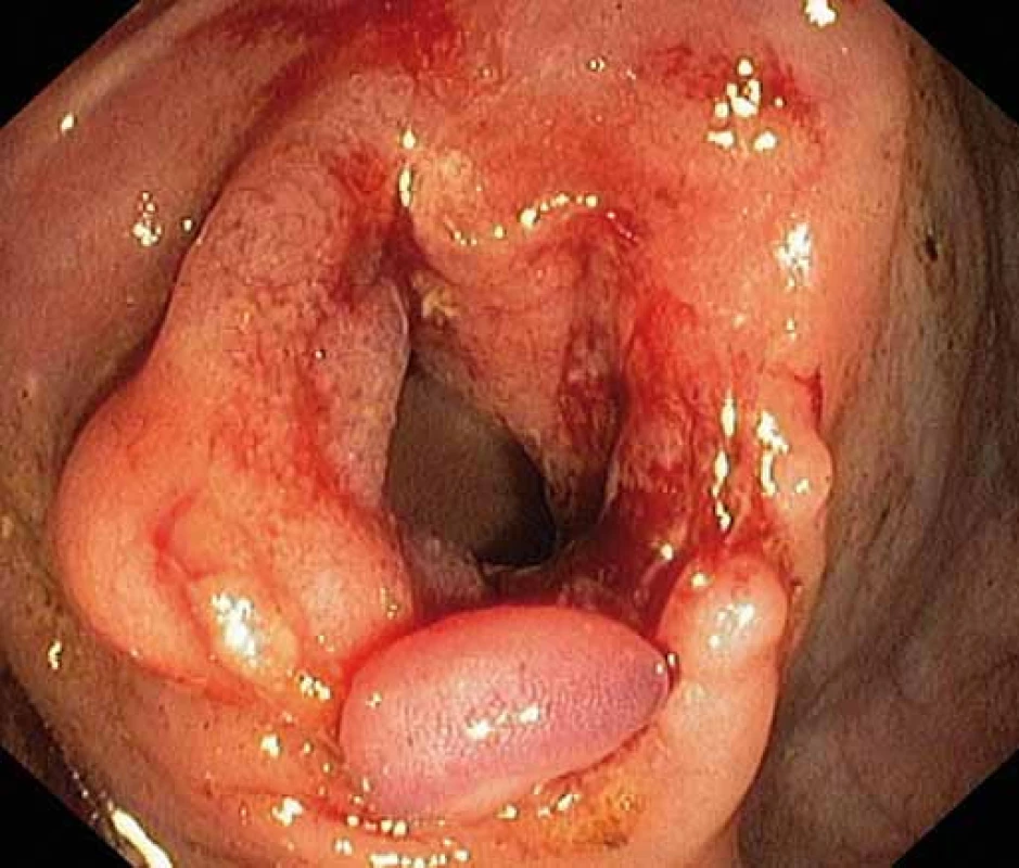 Striktura ileokolické anastomózy po endoskopické balonkové dilataci.
Fig. 2. Stricture of ileocolic anastomosis after endoscopic ballon dilatation.