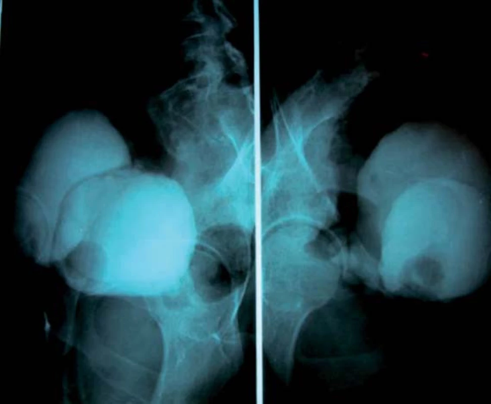 Cystogramy v boční projekci ukazují kompletní duplikaci močového měchýře.