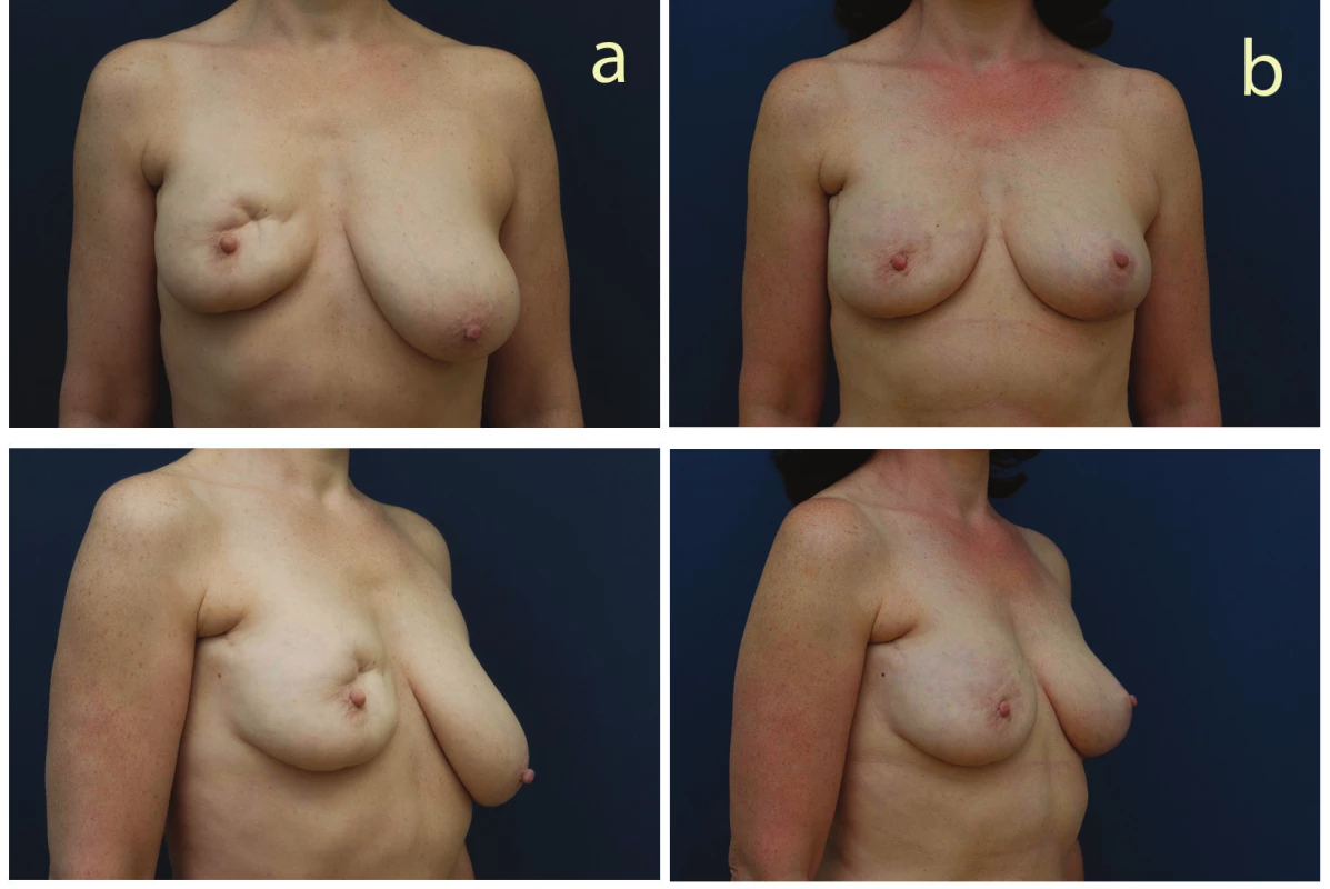 Pacientka po parciální mastektomii vpravo před operací a 6 měsíce po operaci (fatgrafting pravého prsu a modelace levého prsu)
Fig. 2: Patient after partial mastectomy (left) and six months after right breast fat grafting and left breast mastopexy (right)