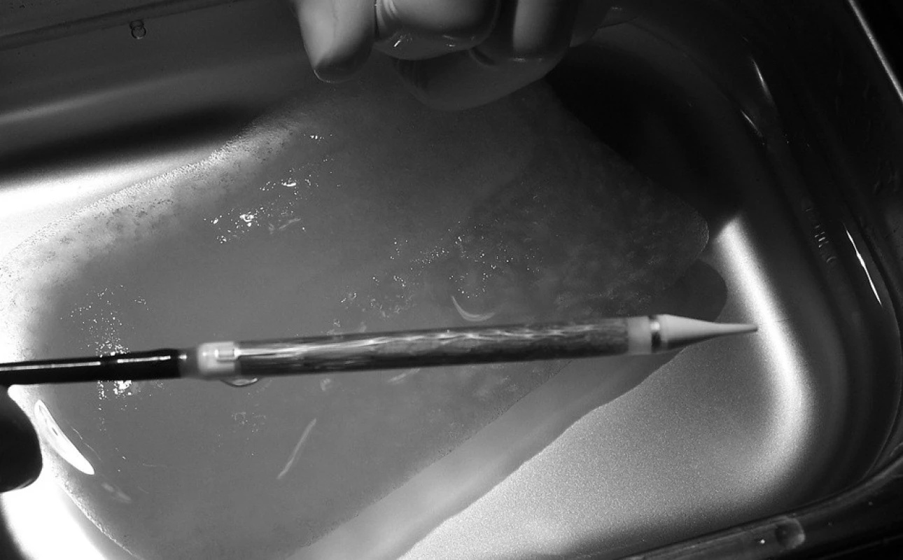Detail chlopně Corevalve<sup>®</sup> umístěné do zaváděcího pouzdra
