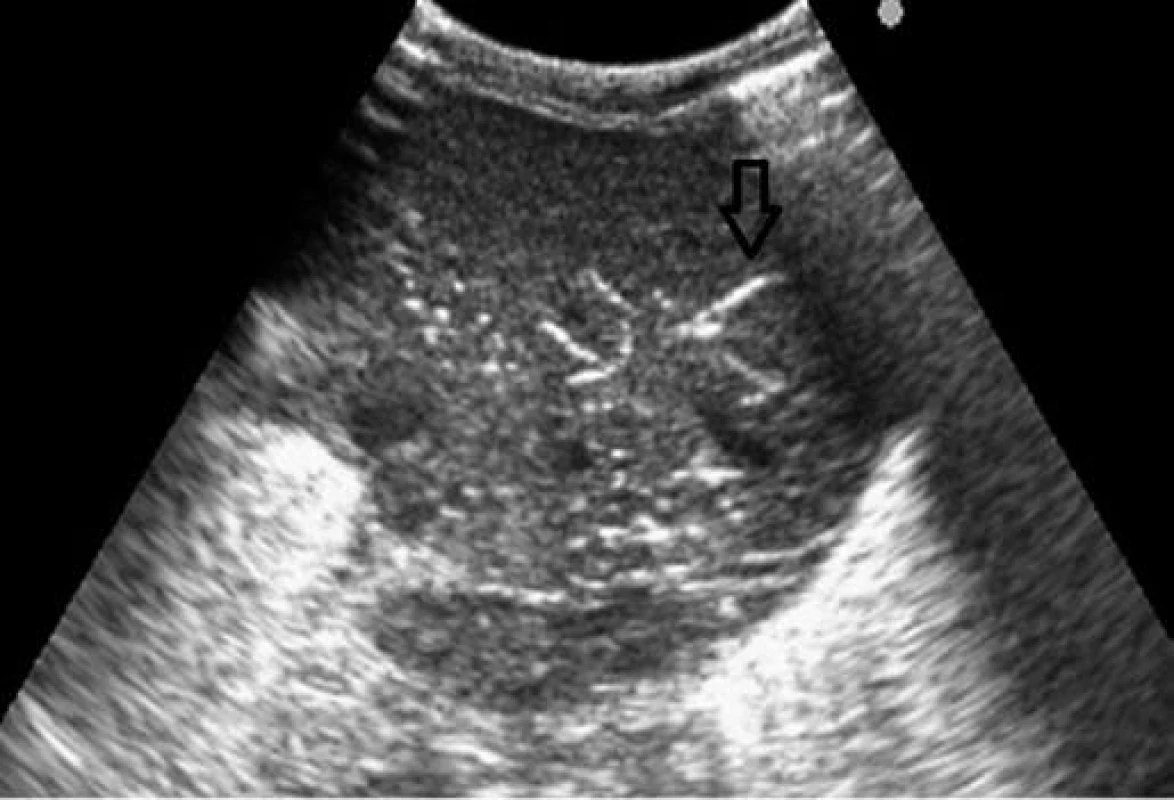 Sonografické vyšetrenie – vzduch v portálnom riečisku.
Fig. 3. Sonographic examination – air in periportal vascular bed.