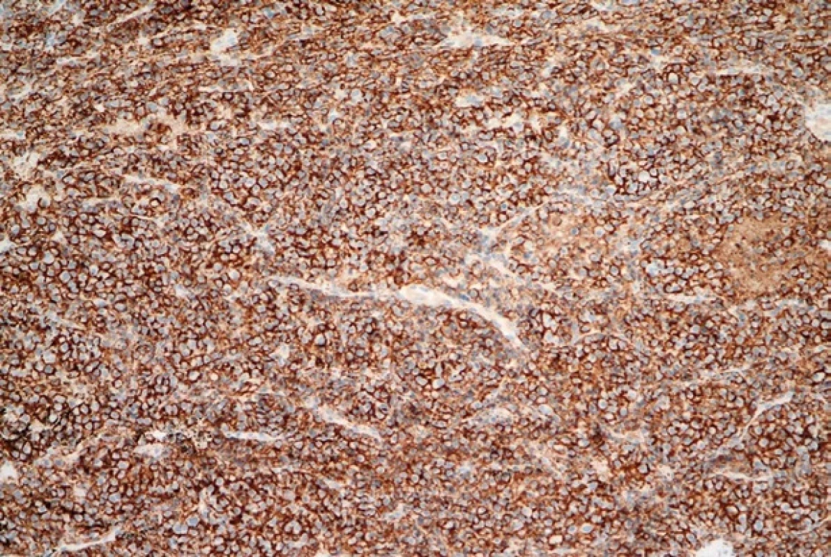 Imunohistochemické barvení (původní zvětšení 200×). Nádorové plazmatické buňky difuzně membránově exprimují marker CD138.
