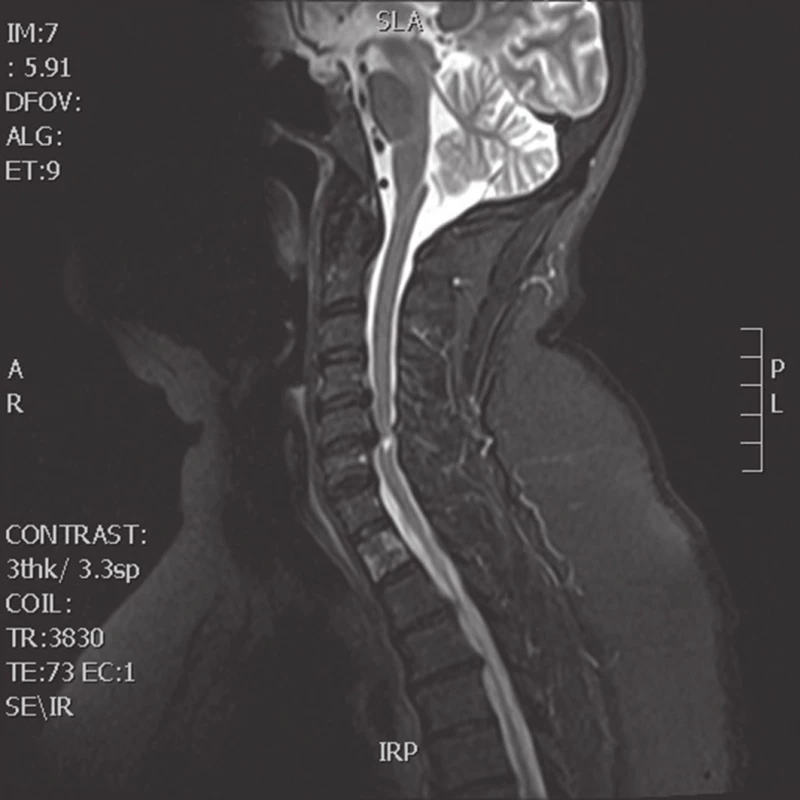MRI krční páteře, sagitální, T2-vážený sken (Žena, 56 let, stenóza páteřního kanálu 6,0 mm a myelopatické změny míchy na etáži C5/6, před operací.)
Fig. 3: cervical spine MRI, T2-weighted sagittal scan (Female patient, 56-year-old, stenosis of the spinal canal of 6.0 mm and myelopathic changes at level C5/6, before surgery)
