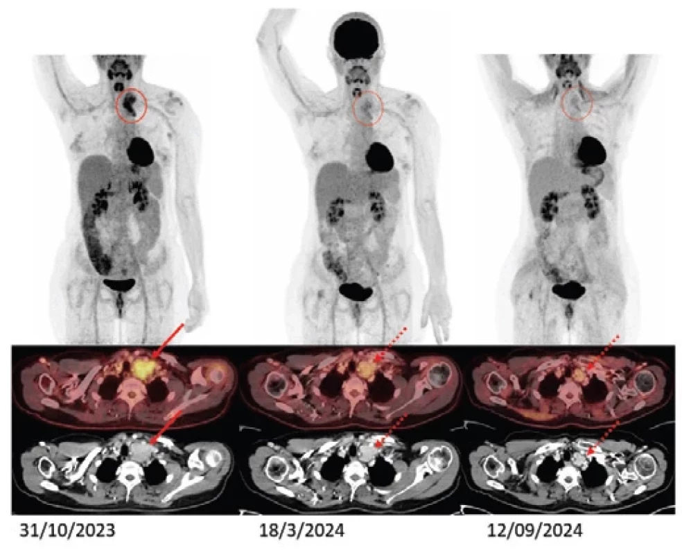 FDG-PET/CT vyšetření trupu s označením sledovaného ložiska.
