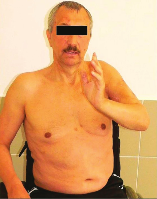 Funkční snímek pacienta po provedení artrodézy ramene
Fig. 3: Functional range of a patient treated by shoulder arthrodesis